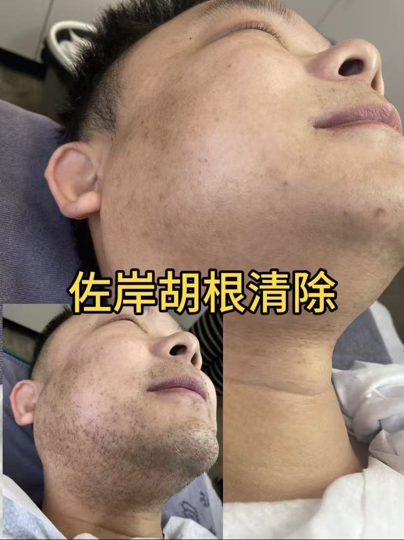 温州脱毛